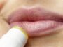 Was hilft gegen Herpes?